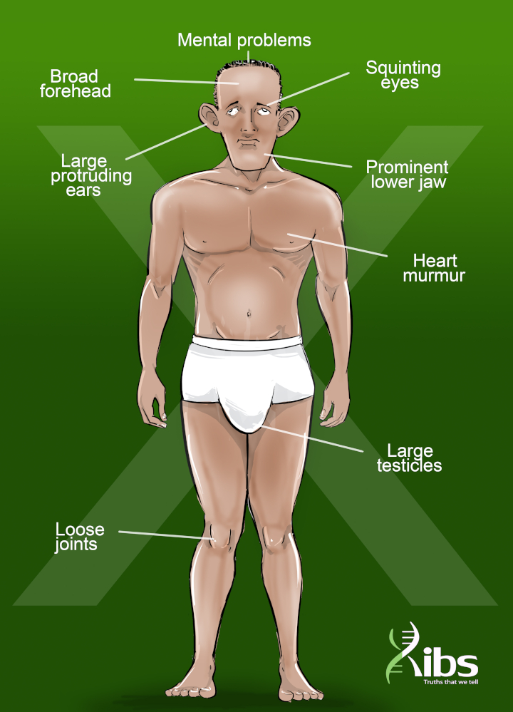 Fragile X Syndrome